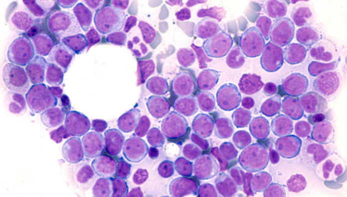 Grant awarded to improve bone marrow cancer treatment